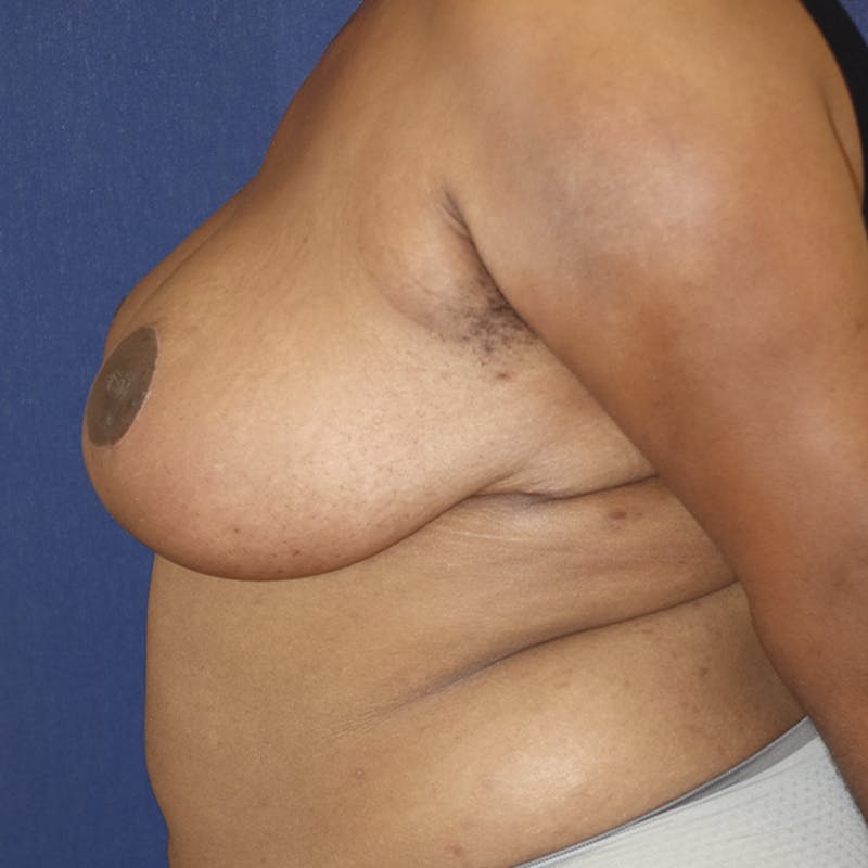 Breast Reduction Before & After Gallery - Patient 369931 - Image 8