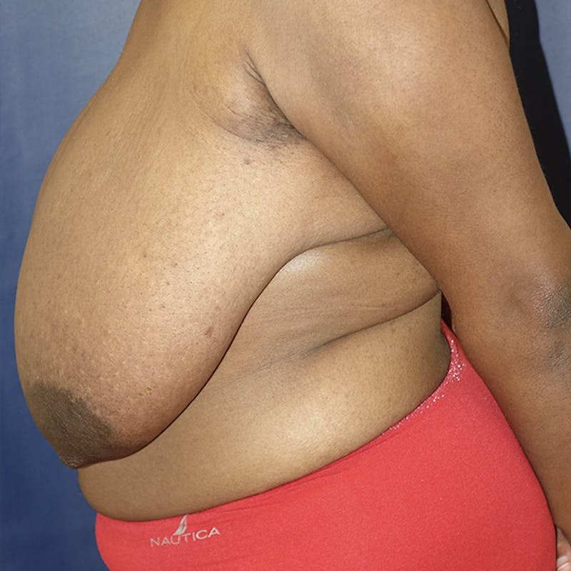 Breast Reduction Before & After Gallery - Patient 369931 - Image 7