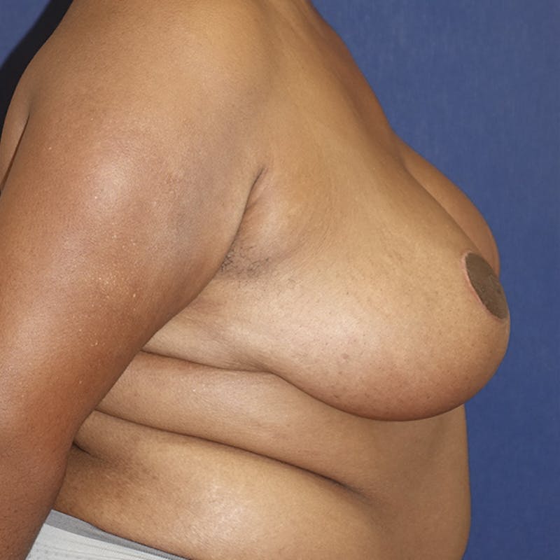Breast Reduction Before & After Gallery - Patient 369931 - Image 6