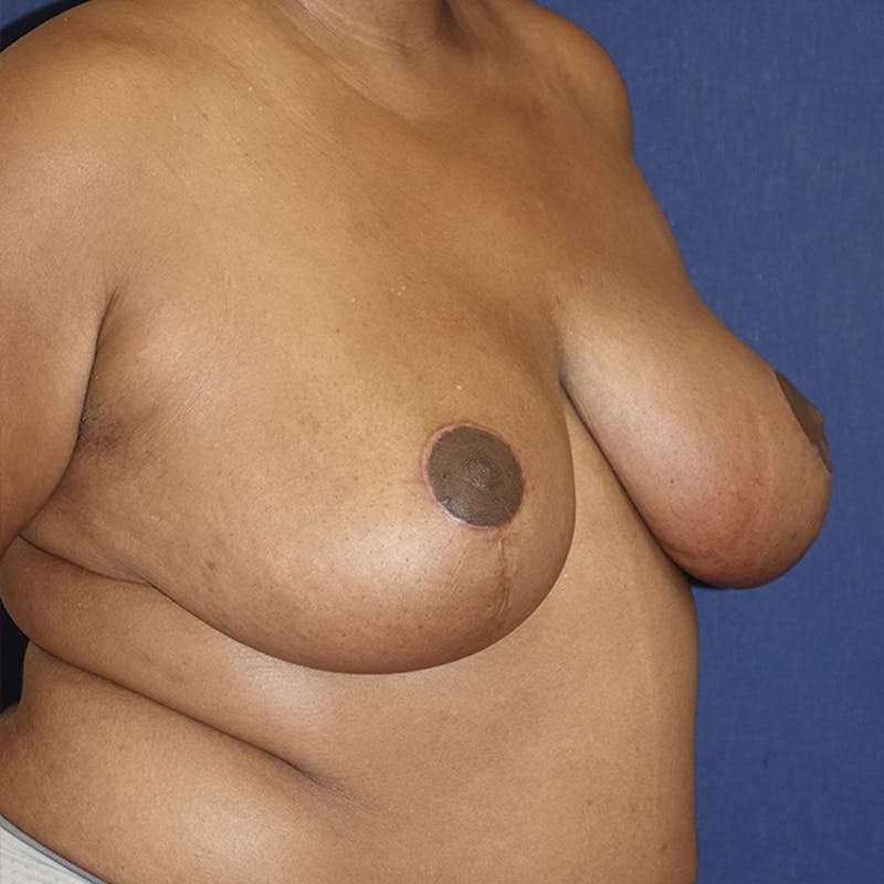 Breast Reduction Before & After Gallery - Patient 369931 - Image 4