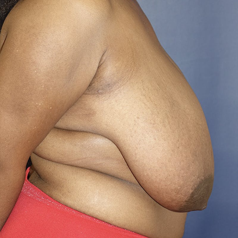 Breast Reduction Before & After Gallery - Patient 369931 - Image 5