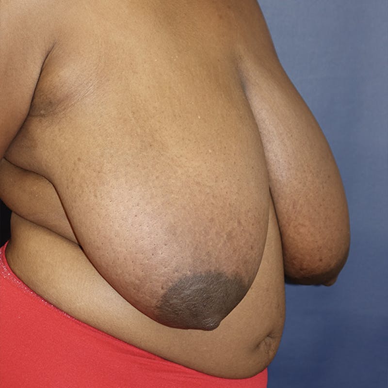 Breast Reduction Before & After Gallery - Patient 369931 - Image 3