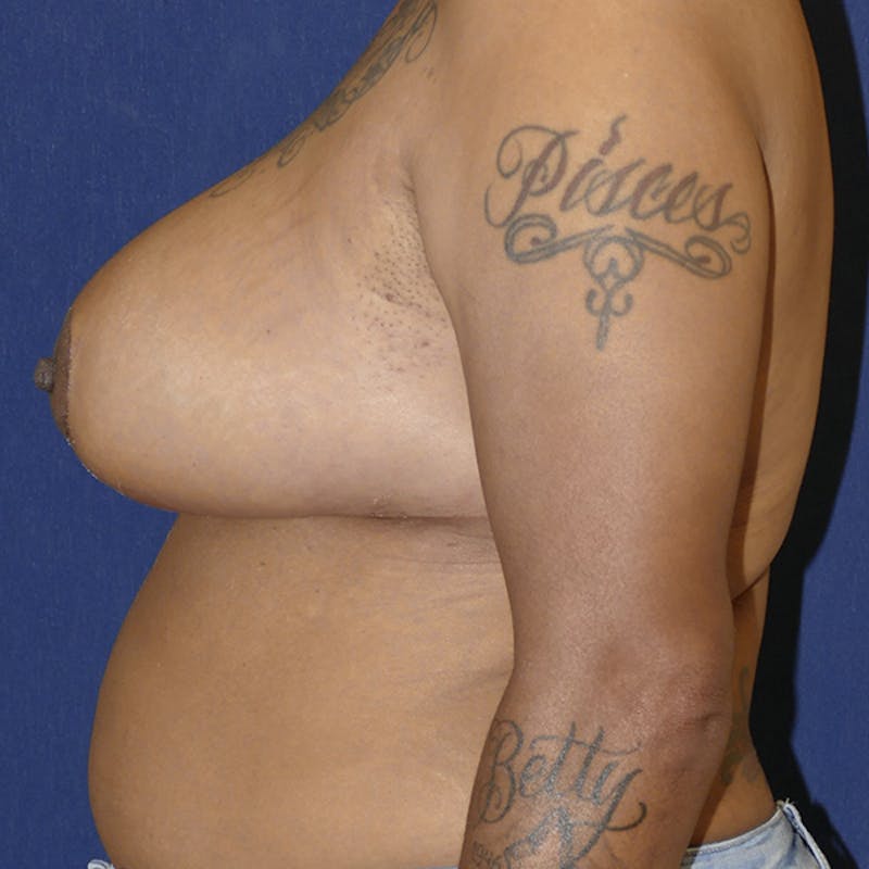 Breast Reduction Before & After Gallery - Patient 359653 - Image 8