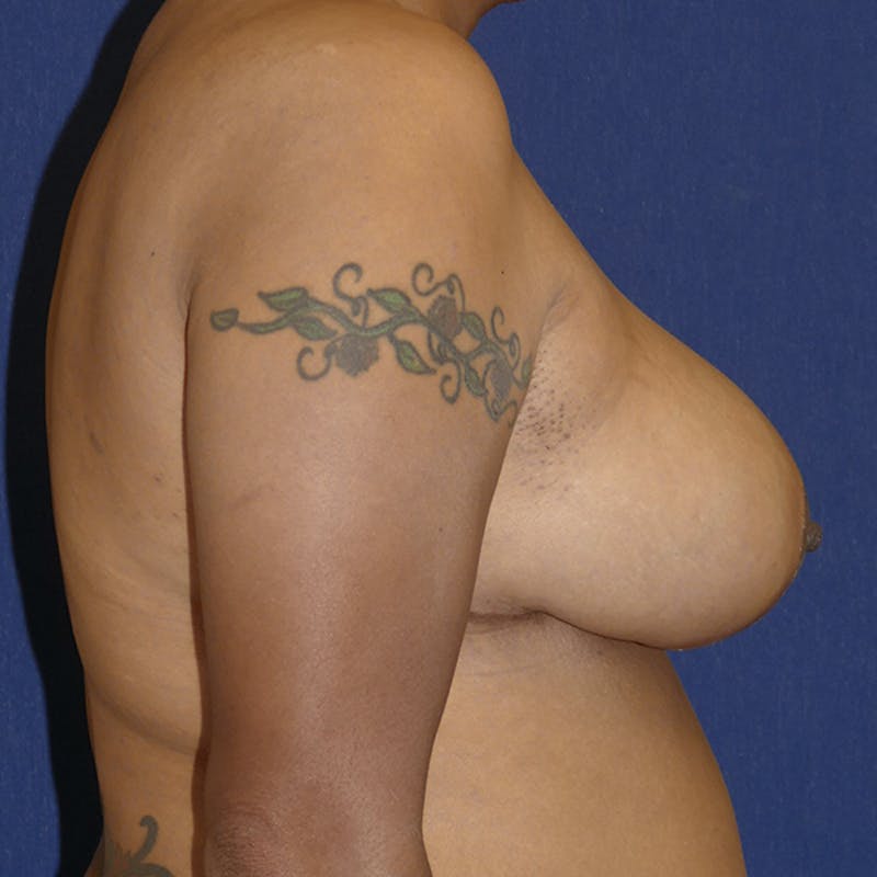 Breast Reduction Before & After Gallery - Patient 359653 - Image 6