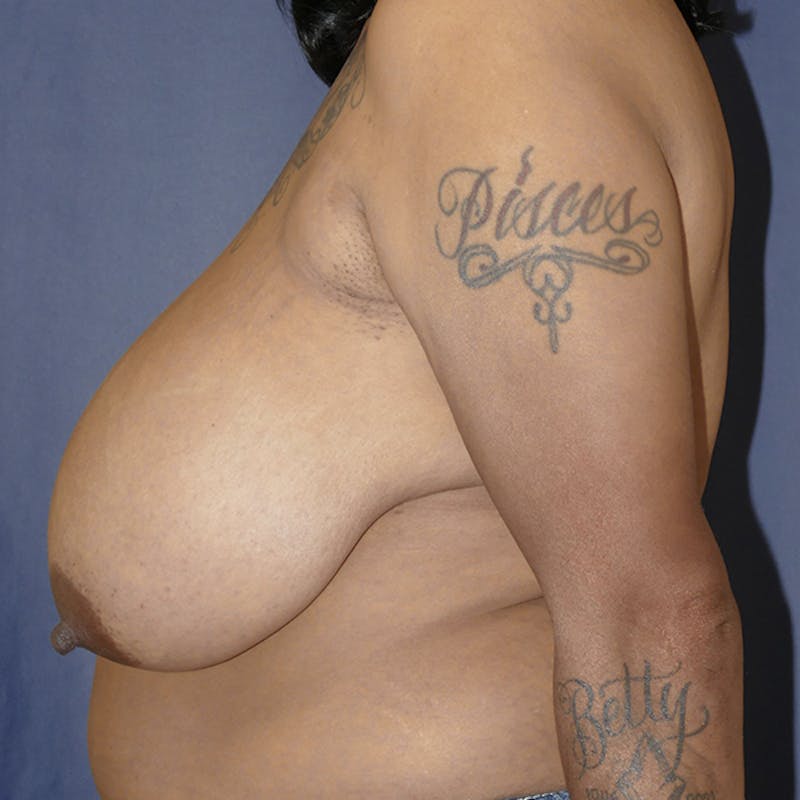 Breast Reduction Before & After Gallery - Patient 359653 - Image 7