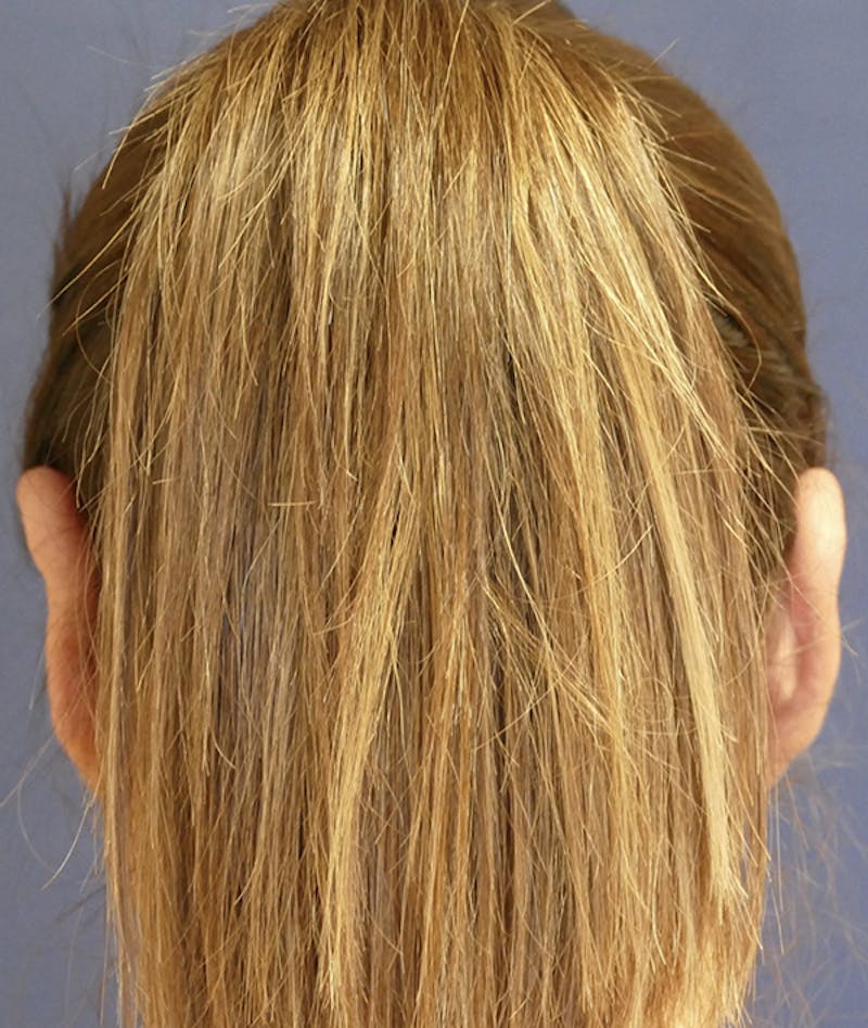 Ear Pinning (Otoplasty) Before & After Gallery - Patient 419513 - Image 12