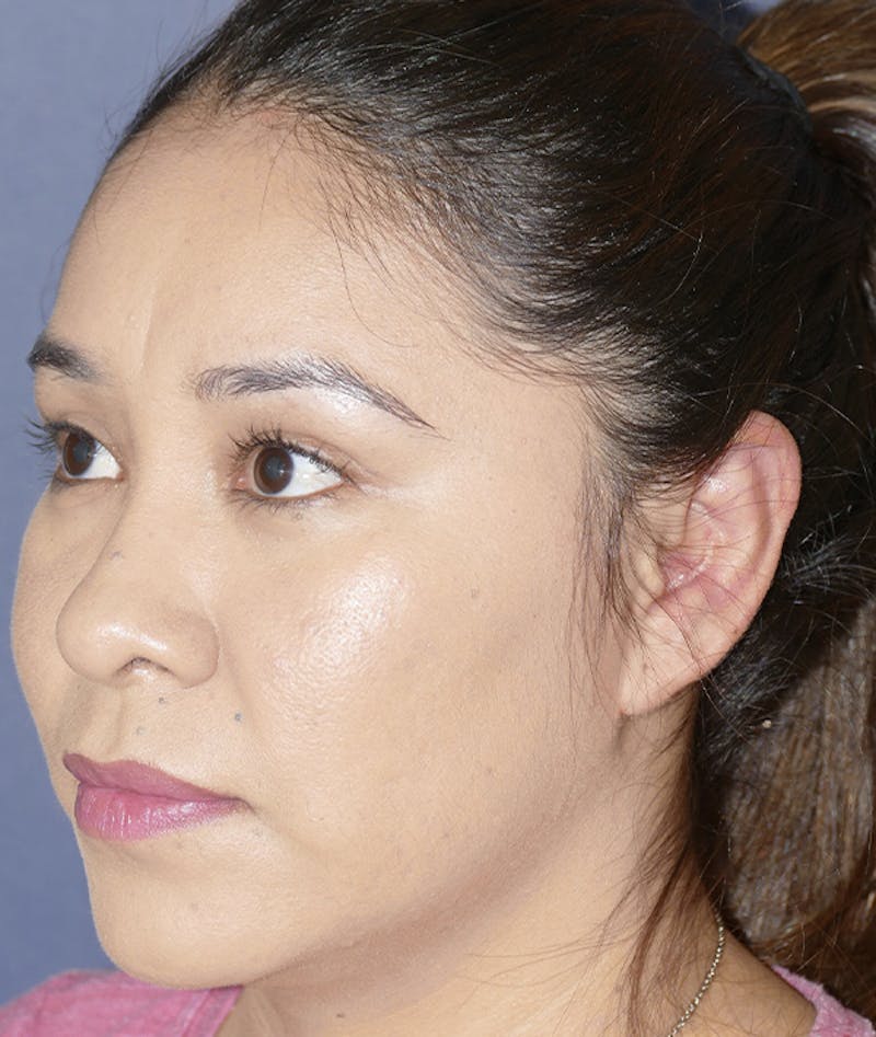 Ear Pinning (Otoplasty) Before & After Gallery - Patient 419513 - Image 10