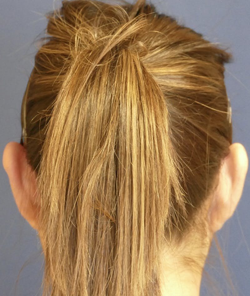 Ear Pinning (Otoplasty) Before & After Gallery - Patient 419513 - Image 11