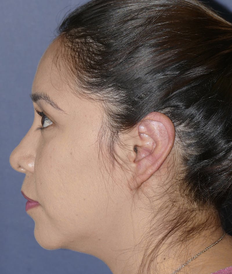 Ear Pinning (Otoplasty) Before & After Gallery - Patient 419513 - Image 8