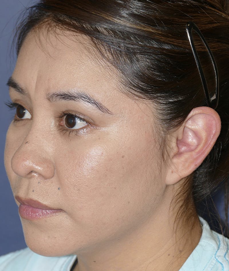 Ear Pinning (Otoplasty) Before & After Gallery - Patient 419513 - Image 9