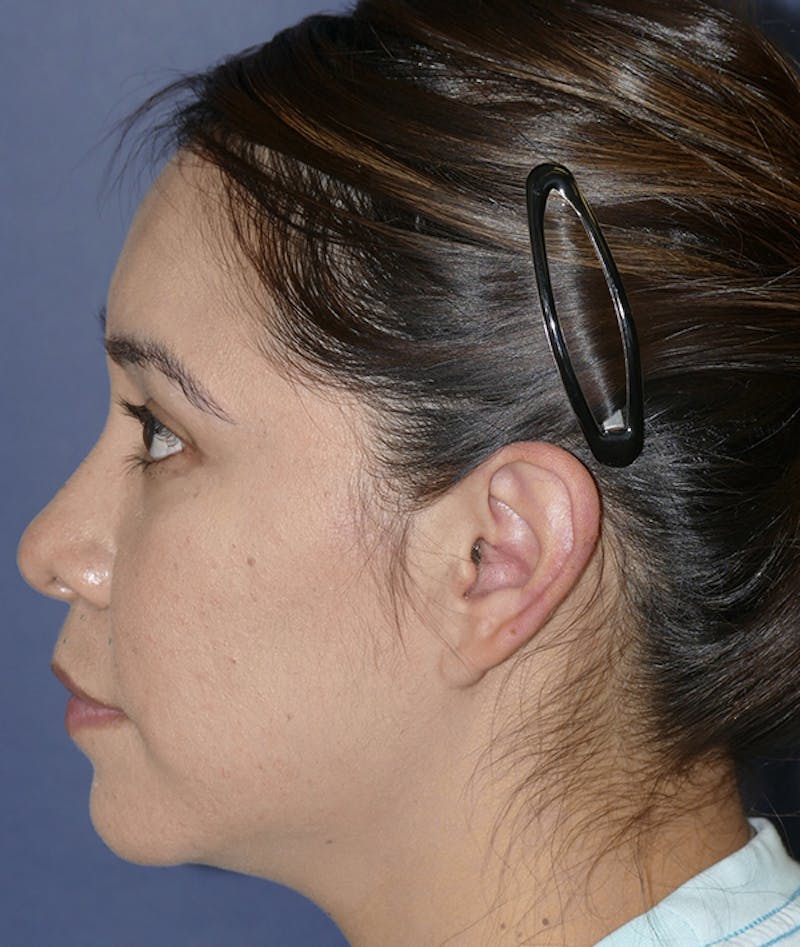 Ear Pinning (Otoplasty) Before & After Gallery - Patient 419513 - Image 7
