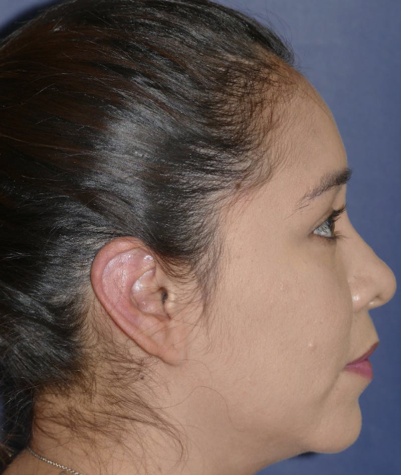 Ear Pinning (Otoplasty) Before & After Gallery - Patient 419513 - Image 6