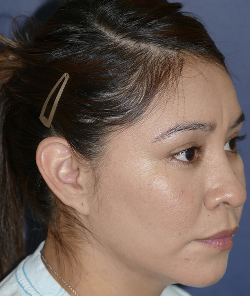 Ear Pinning (Otoplasty) Before & After Gallery - Patient 419513 - Image 3
