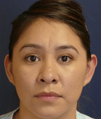 Ear Pinning (Otoplasty) Before & After Gallery - Patient 419513 - Image 1