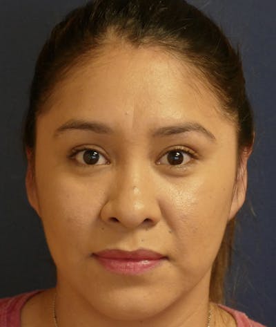 Ear Pinning (Otoplasty) Before & After Gallery - Patient 419513 - Image 2