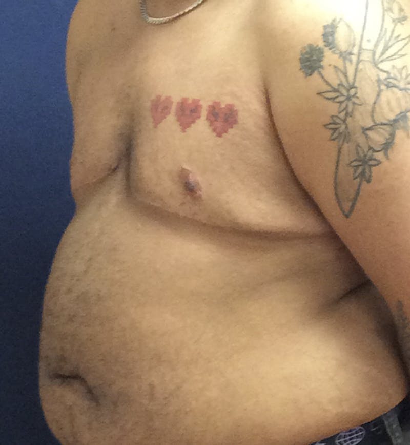 Masculinizing Surgery Before & After Gallery - Patient 254706 - Image 10