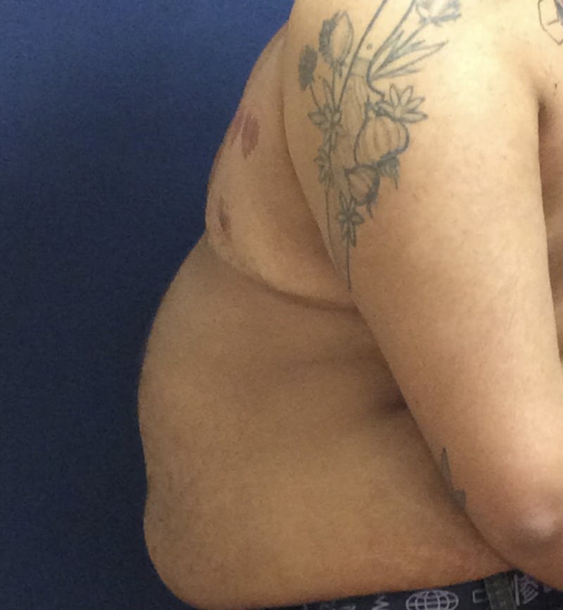 Masculinizing Surgery Before & After Gallery - Patient 254706 - Image 8