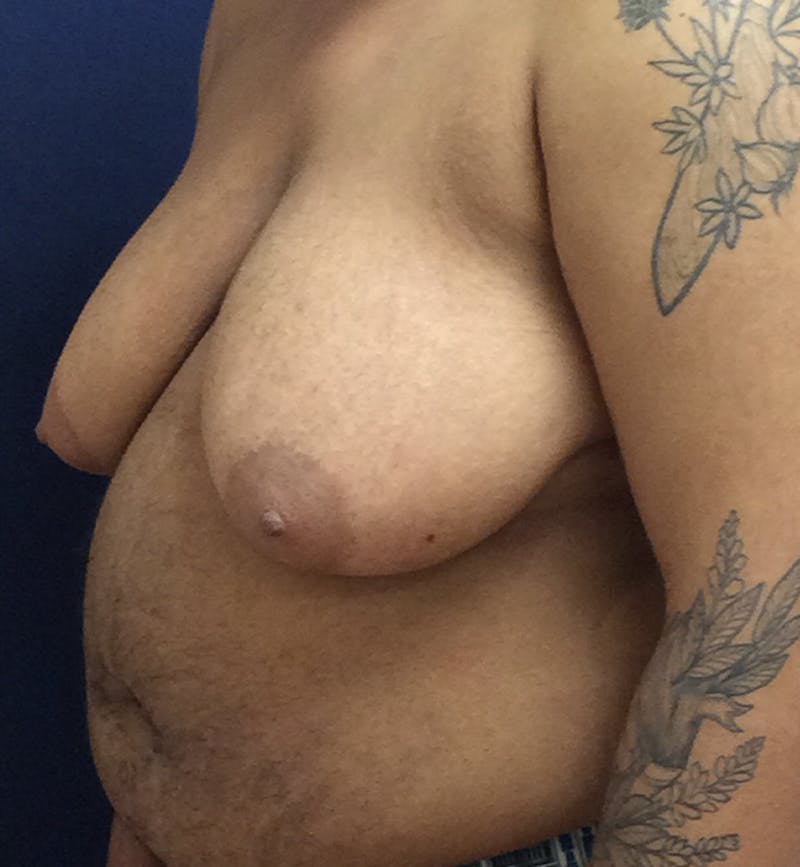 Masculinizing Surgery Before & After Gallery - Patient 254706 - Image 9