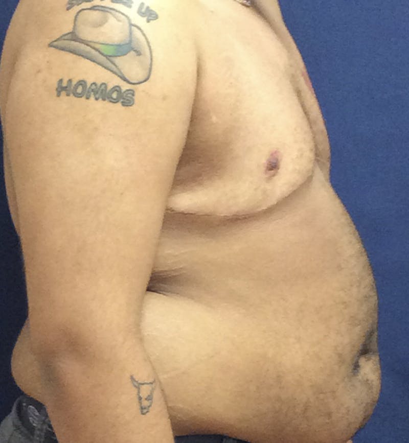 Masculinizing Surgery Before & After Gallery - Patient 254706 - Image 6