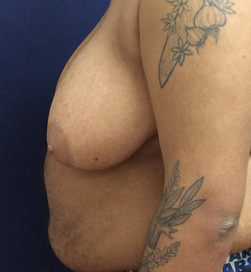 Masculinizing Surgery Before & After Gallery - Patient 254706 - Image 7