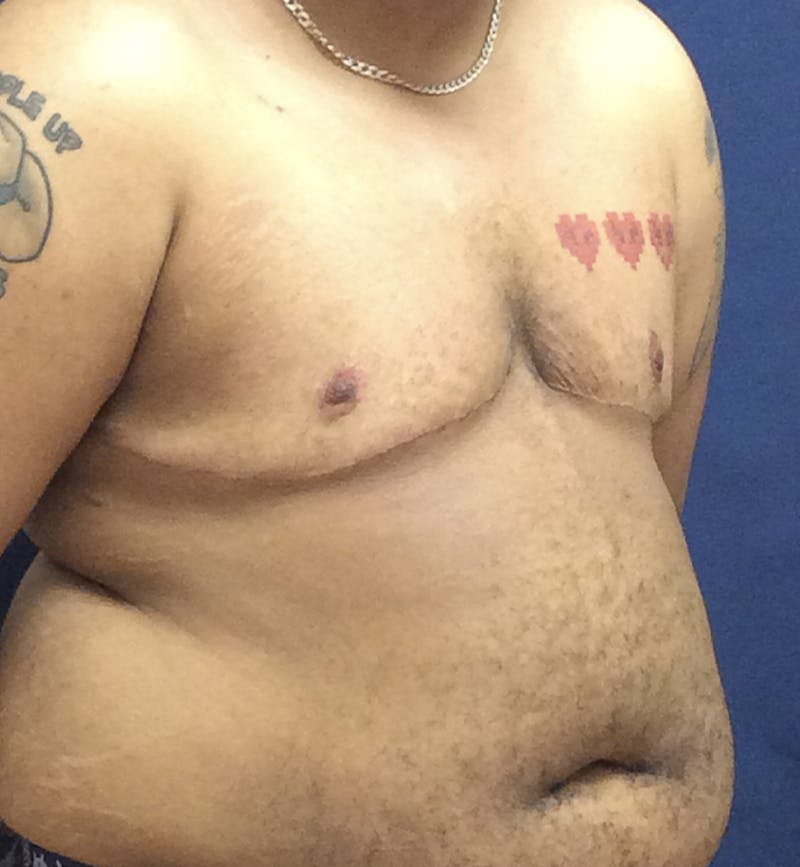Masculinizing Surgery Before & After Gallery - Patient 254706 - Image 4