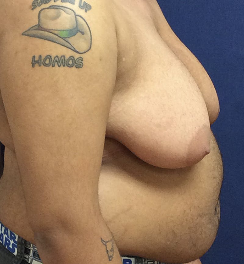 Masculinizing Surgery Before & After Gallery - Patient 254706 - Image 5