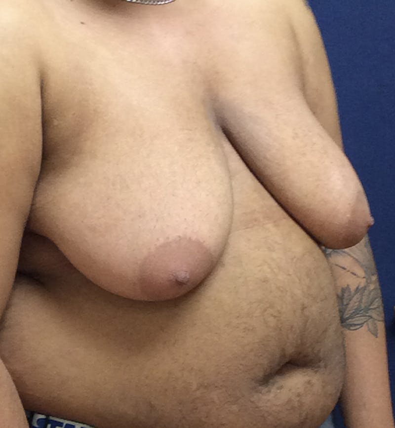 Masculinizing Surgery Before & After Gallery - Patient 254706 - Image 3