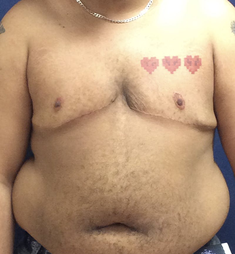 Masculinizing Surgery Before & After Gallery - Patient 254706 - Image 2