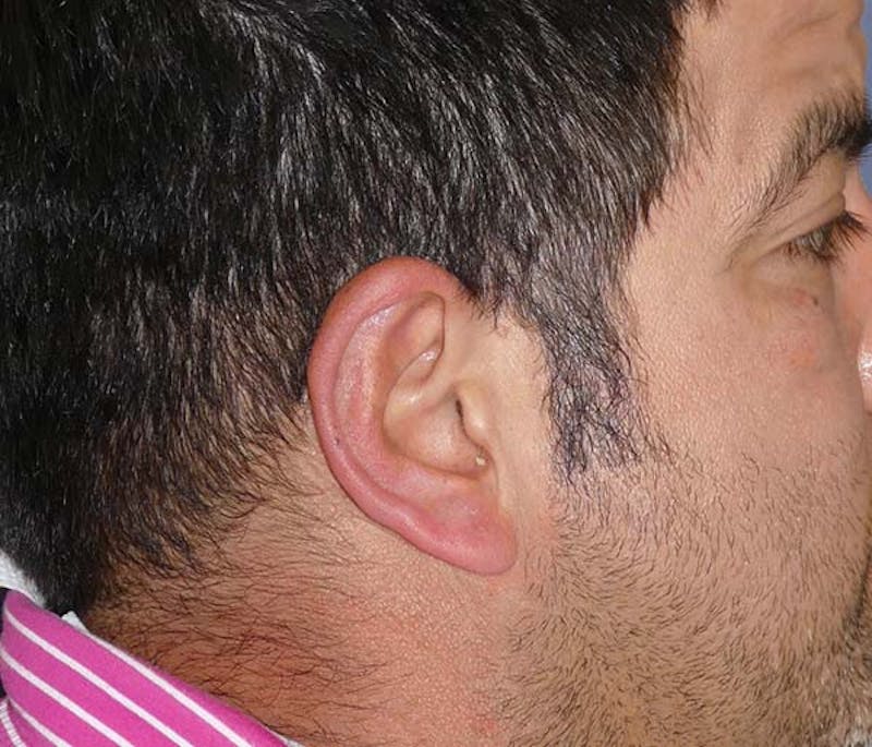 Ear Pinning (Otoplasty) Before & After Gallery - Patient 849865 - Image 6