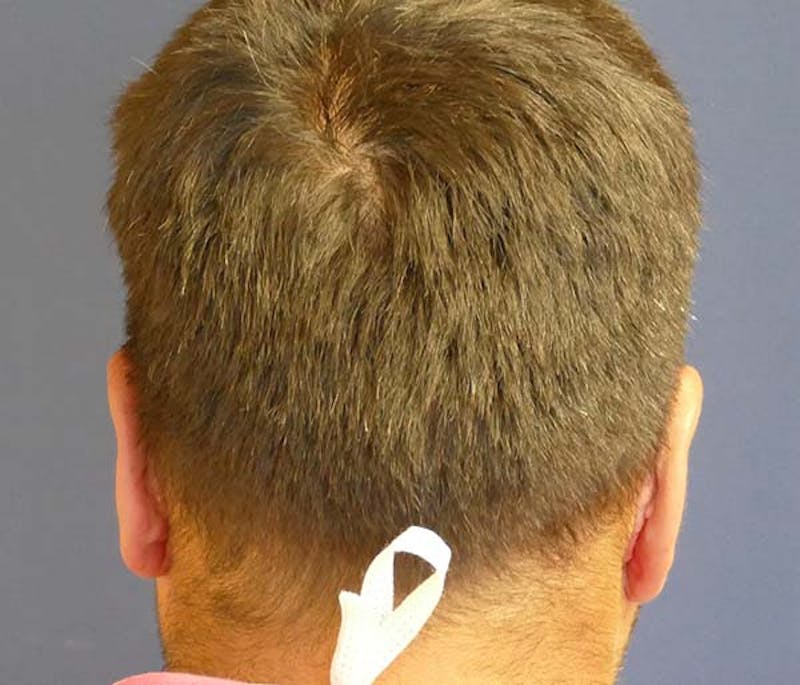 Ear Pinning (Otoplasty) Before & After Gallery - Patient 849865 - Image 4