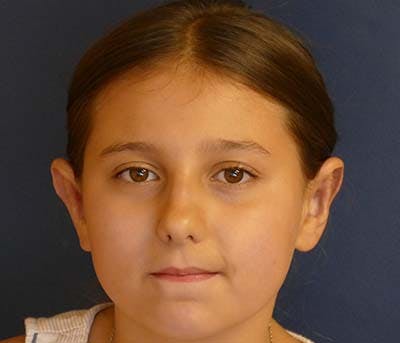 Otoplasty Before & After Gallery - Patient 378363 - Image 2