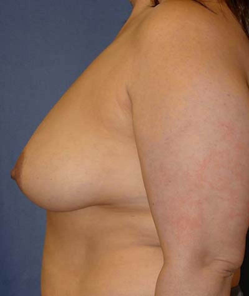 Breast Lift Before & After Gallery - Patient 182986 - Image 9
