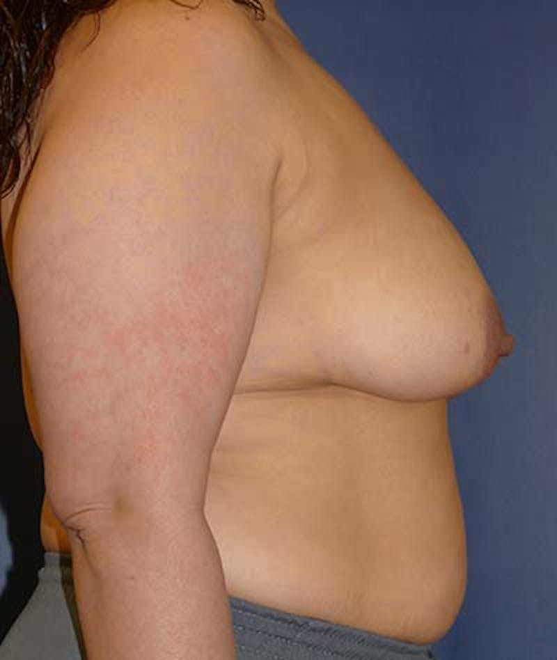 Breast Lift Before & After Gallery - Patient 182986 - Image 5