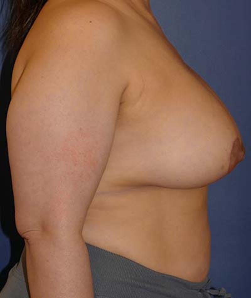 Breast Lift Before & After Gallery - Patient 182986 - Image 6