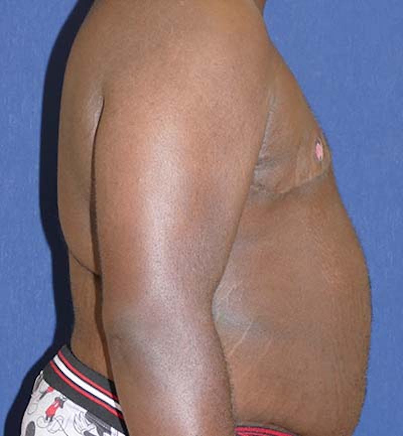 Masculinizing Surgery Before & After Gallery - Patient 318046 - Image 6