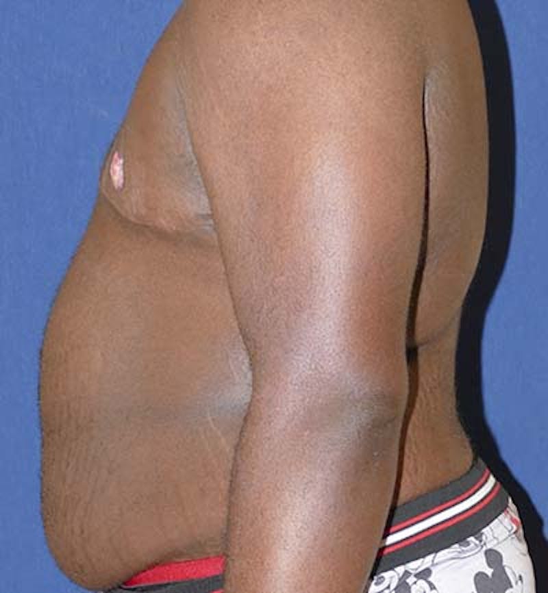 Masculinizing Surgery Before & After Gallery - Patient 318046 - Image 4