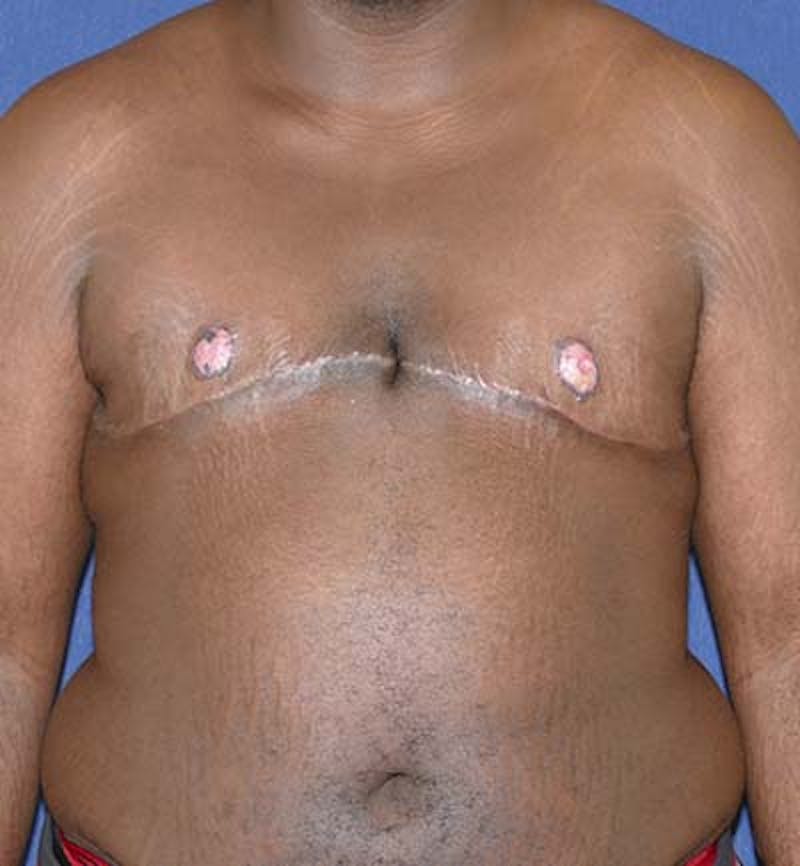 Masculinizing Surgery Before & After Gallery - Patient 318046 - Image 2