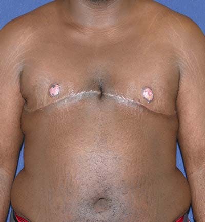 Masculinizing Surgery Before & After Gallery - Patient 318046 - Image 2