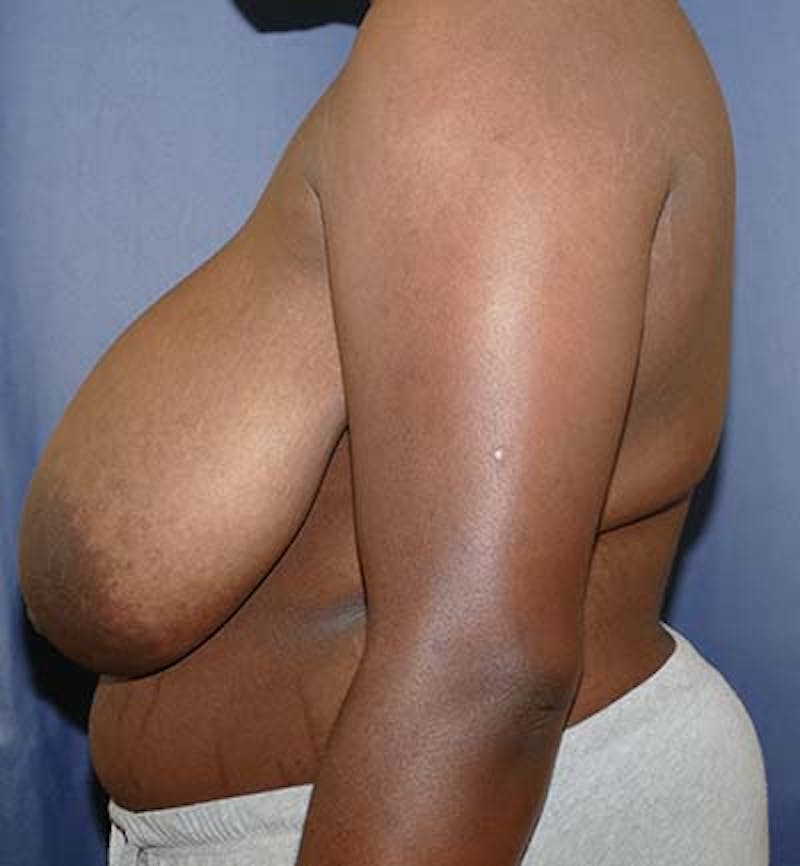Masculinizing Surgery Before & After Gallery - Patient 318046 - Image 3