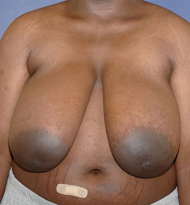 Masculinizing Surgery Before & After Gallery - Patient 318046 - Image 1
