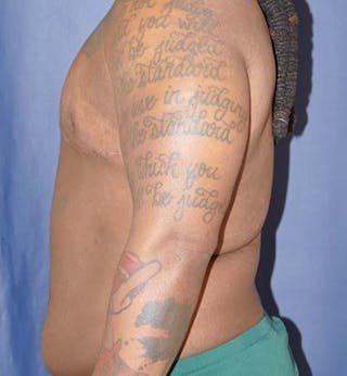 Masculinizing Surgery Before & After Gallery - Patient 295138 - Image 4