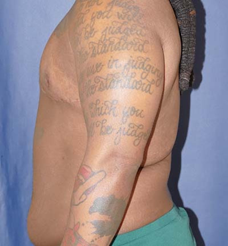 Masculinizing Surgery Before & After Gallery - Patient 295138 - Image 4