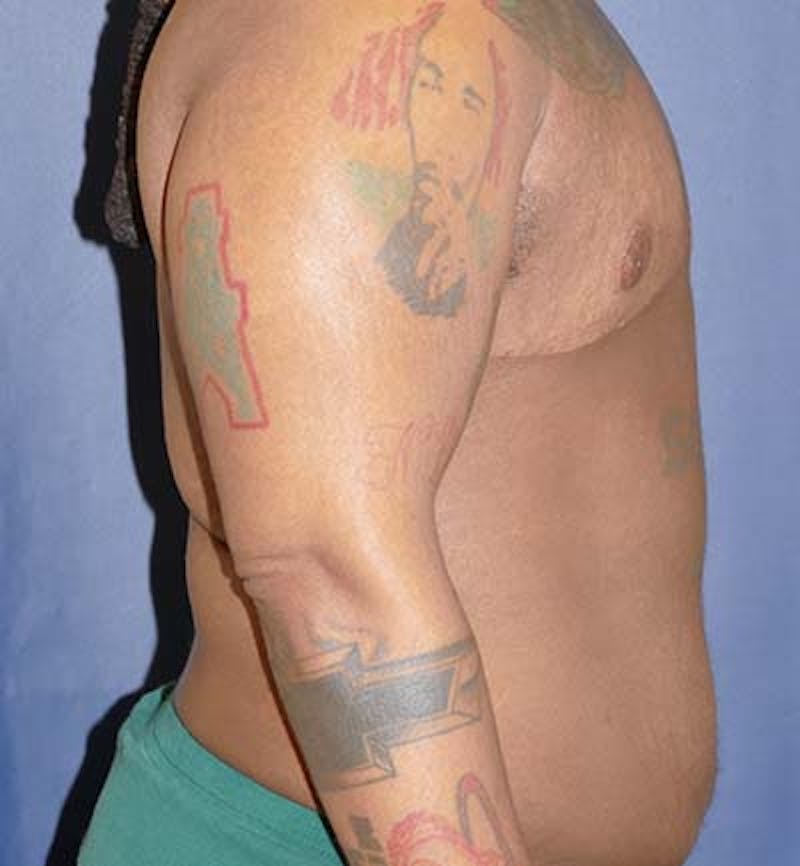 Masculinizing Surgery Before & After Gallery - Patient 295138 - Image 5