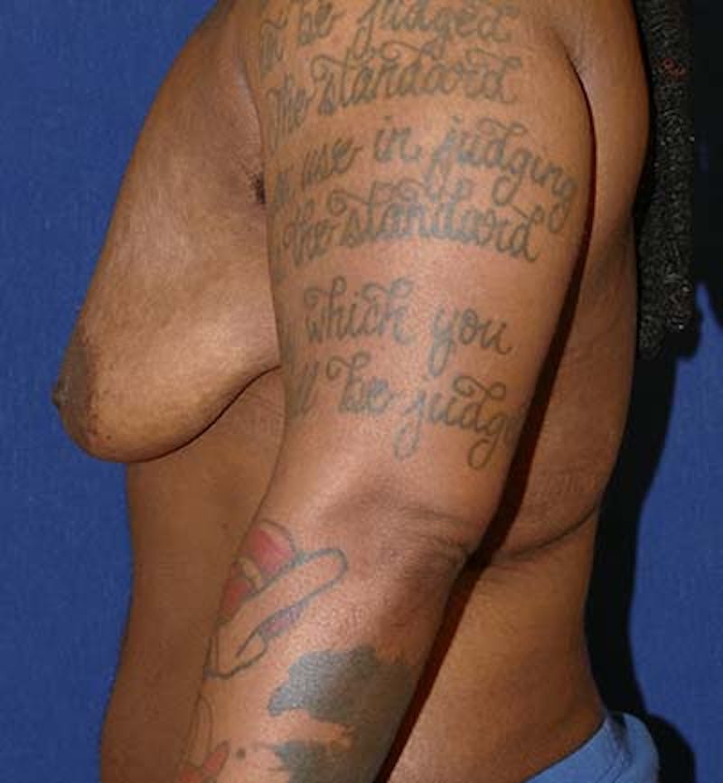Masculinizing Surgery Before & After Gallery - Patient 295138 - Image 3