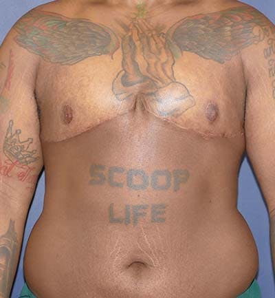 Masculinizing Surgery Before & After Gallery - Patient 295138 - Image 2