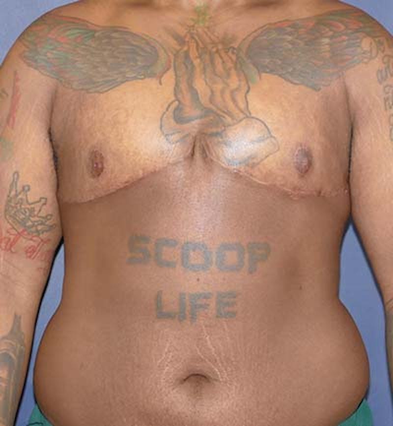 Masculinizing Surgery Before & After Gallery - Patient 295138 - Image 2