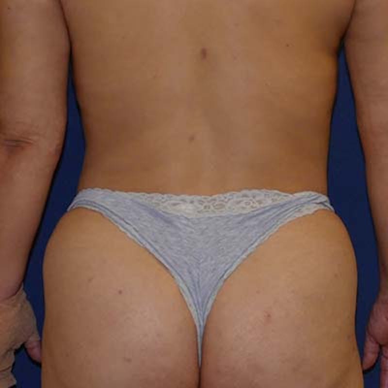 Liposuction Before & After Gallery - Patient 201625 - Image 12