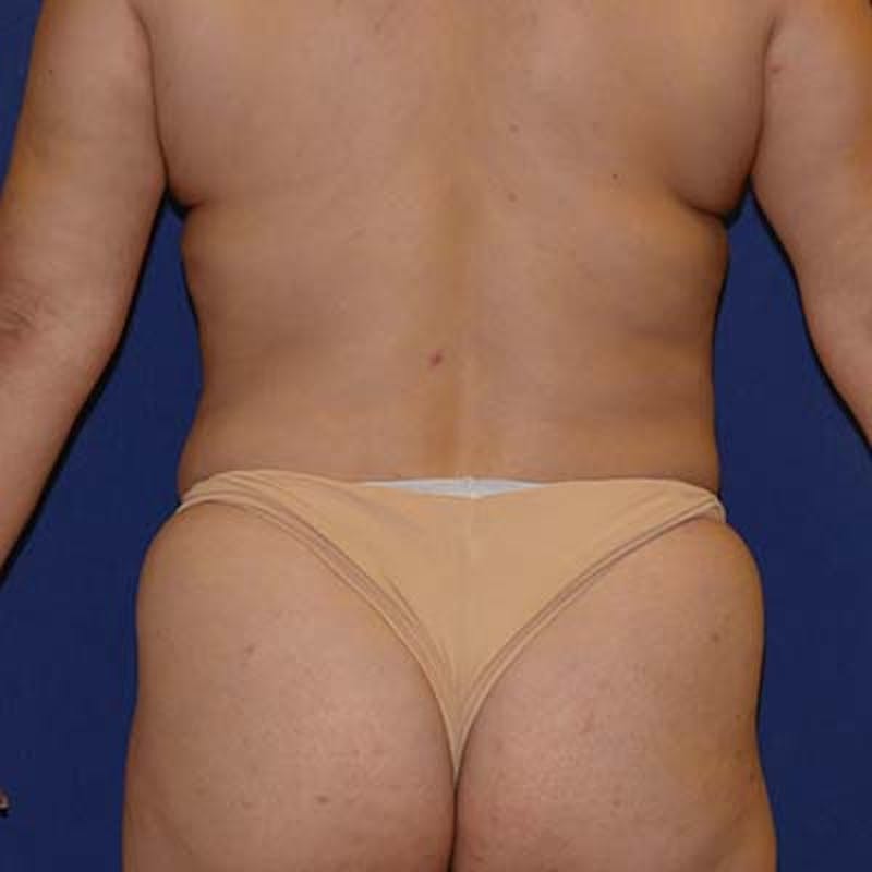 Liposuction Before & After Gallery - Patient 201625 - Image 11