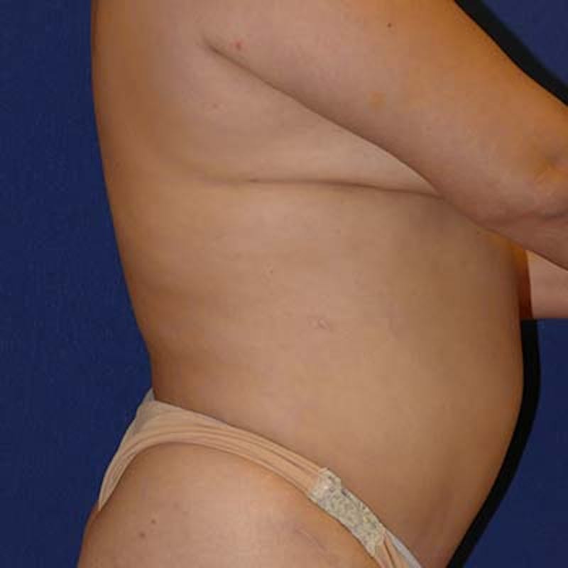 Liposuction Before & After Gallery - Patient 201625 - Image 5