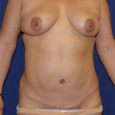 Liposuction Before & After Gallery - Patient 201625 - Image 1